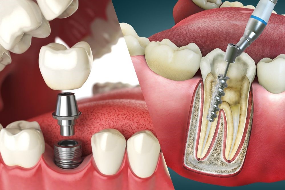 Dental Implants vs Root Canal:Â Which is the Better Option?