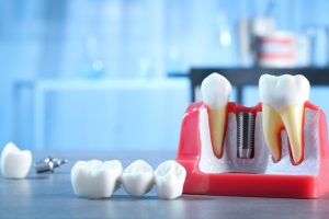 best dental implants London